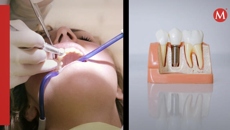 Los implantes son la única opción actualmente ante la pérdida de piezas dentales. | ESPECIAL
